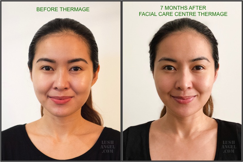 Before and After Thermage Photos.