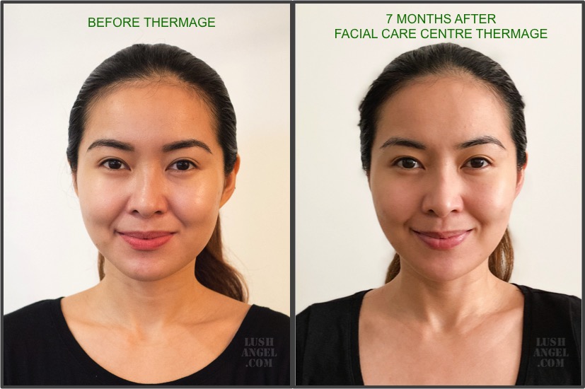 Facial Care Centre Thermage Review + Before and After Photos Lush Angel